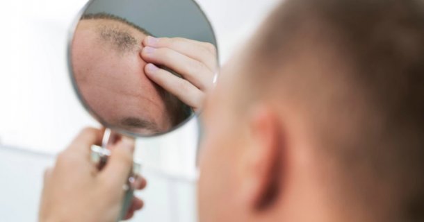 Se aprobó un medicamento que podría curar la alopecia