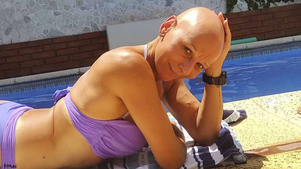 La historia de la mujer que sufre alopecia y ya no lo esconde