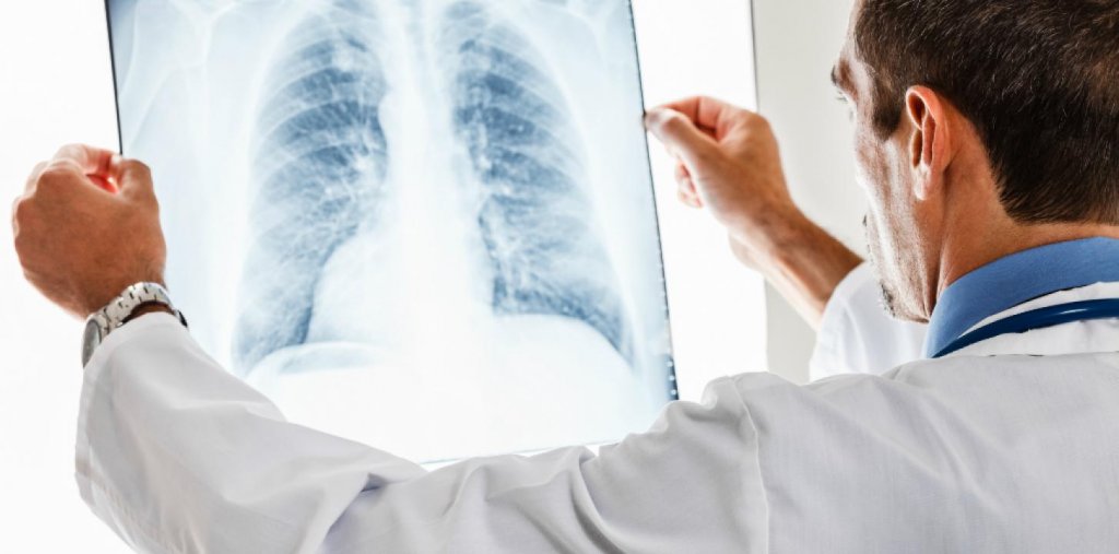 Aprueban un nuevo tratamiento para el cáncer de pulmón